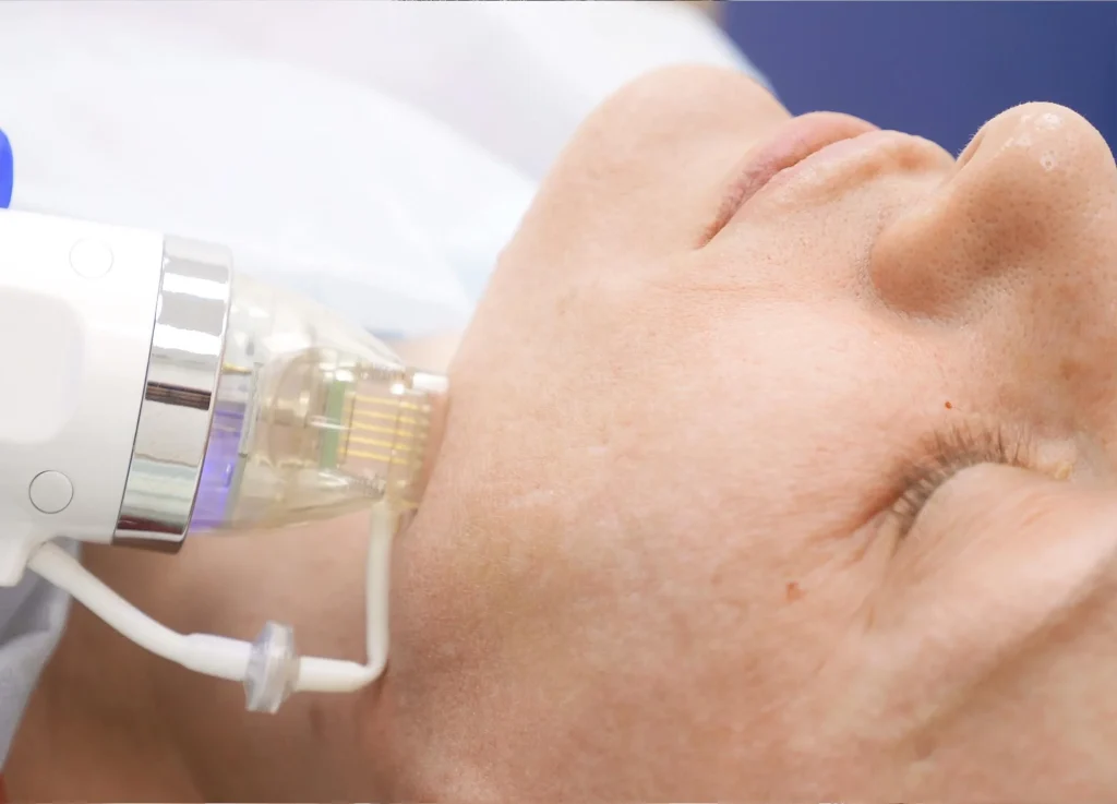 RF, Microneedling & RF Microneedling: What’s the Difference? 3 A woman receiving skin procedures