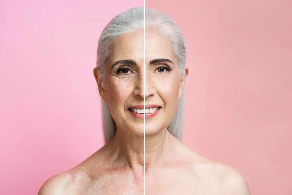 A split image showing the effects of anti-aging treatment on an older woman’s face.
