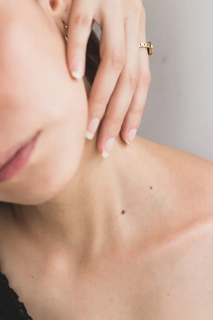 Close-up of a woman’s neck and collarbone with two visible moles, her hand resting near her jaw and a gold ring on her finger.