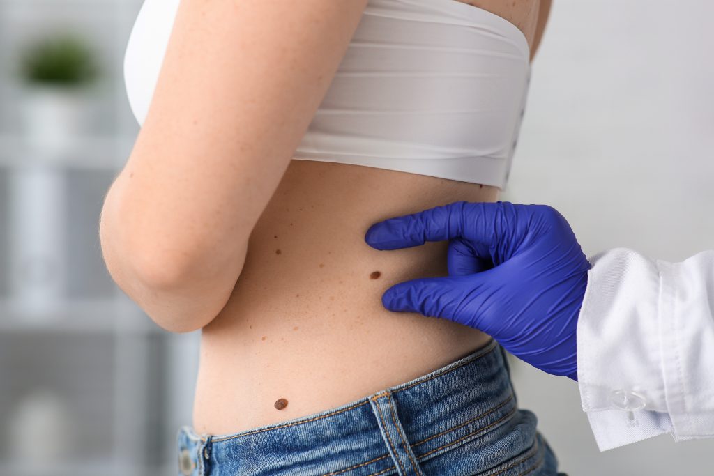 When Should a Mole or Skin Tag Be Removed? 3