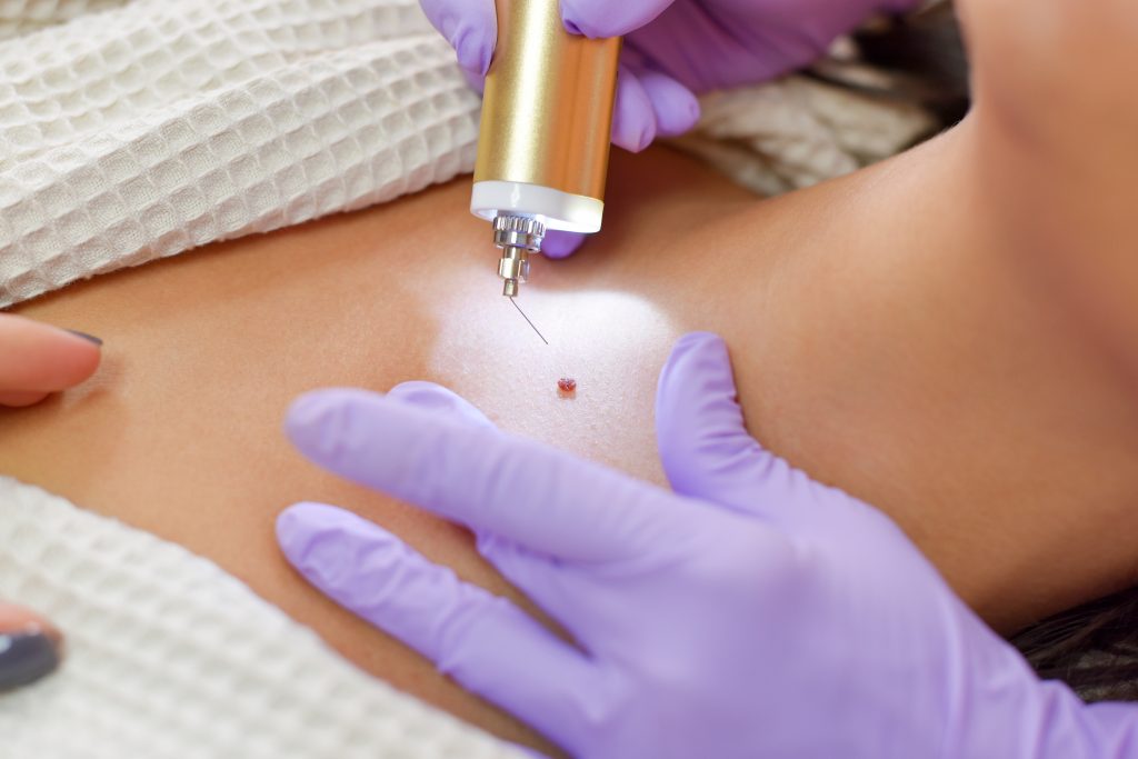 When Should a Mole or Skin Tag Be Removed? 4