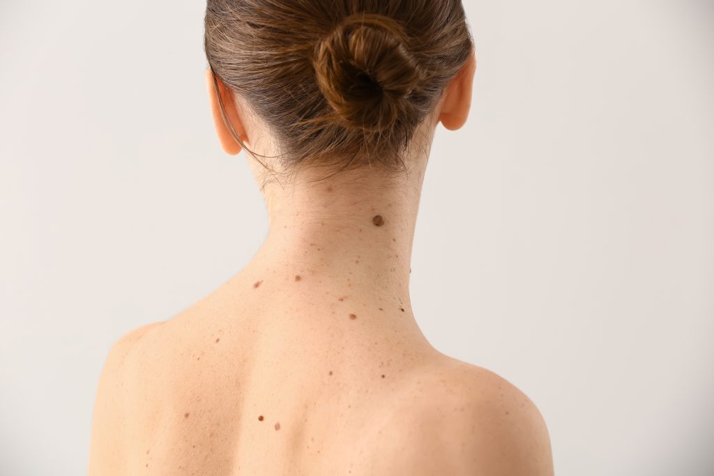 When Should a Mole or Skin Tag Be Removed? 1