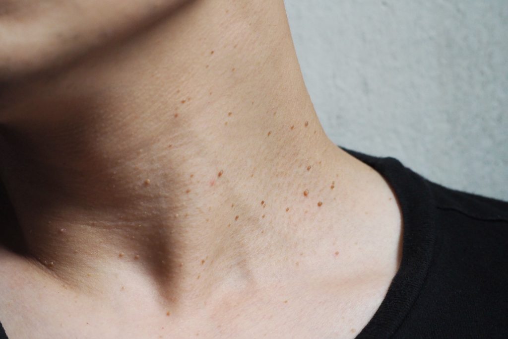 When Should a Mole or Skin Tag Be Removed? 2